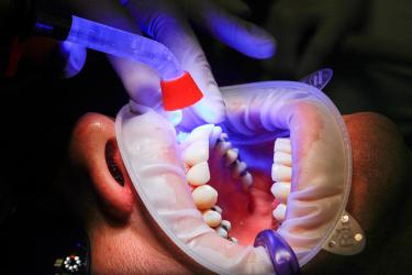 Implanty czy wybielanie zębów ?